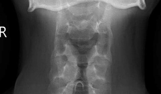 Đau cột sống cổ âm ỉ 5 tháng, nam thanh niên 26 tuổi phát hiện viêm cột sống dính khớp