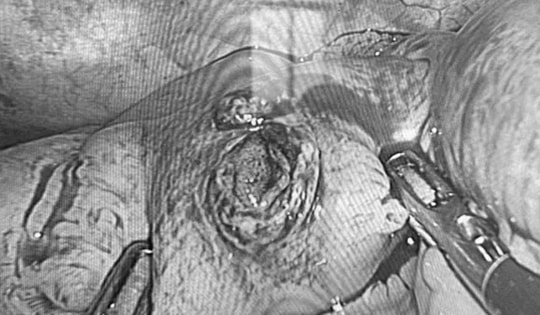 Phẫu thuật nội soi cấp cứu thành công cho nam thanh niên bị đinh xuyên thủng ruột non