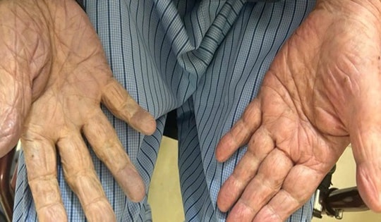 Hút nhiều cục máu đông cứu cụ ông 97 tuổi khỏi nguy cơ cắt cụt tay