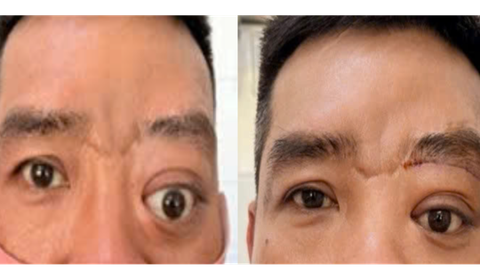 Bệnh hiếm gây lồi mắt, 20 năm Bệnh viện Tai Mũi Họng TPHCM chỉ gặp 2 ca