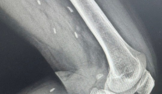 
Phát hiện nhiều kén sán ở chân bệnh nhân do một thói quen thường gặp