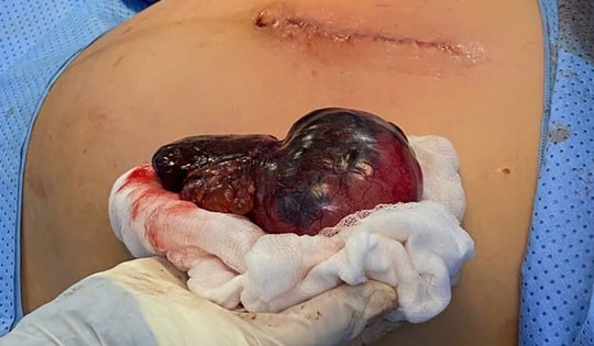 Thai phụ 34 tuần nguy kịch vì u buồng trứng xoắn hoại tử