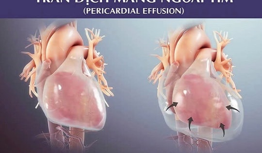 Cấp cứu bệnh nhi bị tràn dịch màng ngoài tim nguy kịch