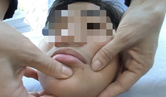 Nhiều ca nhập viện bị liệt mặt, méo miệng do rét đậm