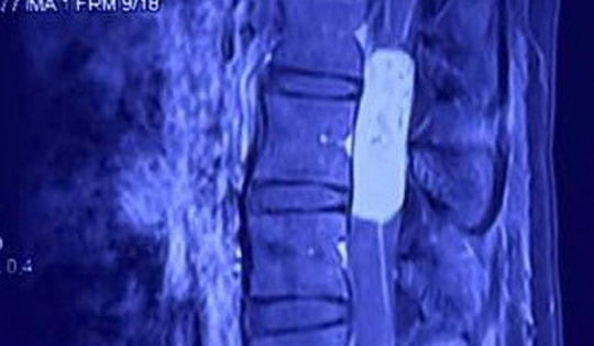 Hạnh phúc nghẹn ngào của người mẹ trẻ sau ca vi phẫu loại bỏ khối u tủy gần 10cm