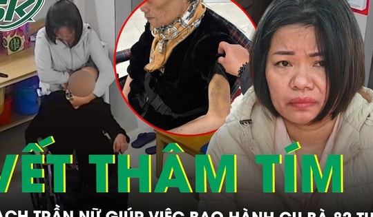Vết thâm tím vạch trần hành vi độc ác của nữ giúp việc bạo hành cụ bà 82 tuổi ở Hà Nội