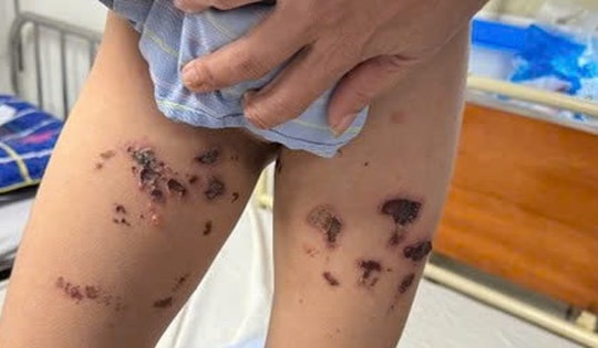 Bé trai bỏng nặng tầng sinh môn do nước tẩy tẩy bồn cầu bắn vào người