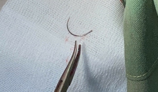 Kim khâu 'mắc kẹt' 11 năm ở tầng sinh môn của bệnh nhân