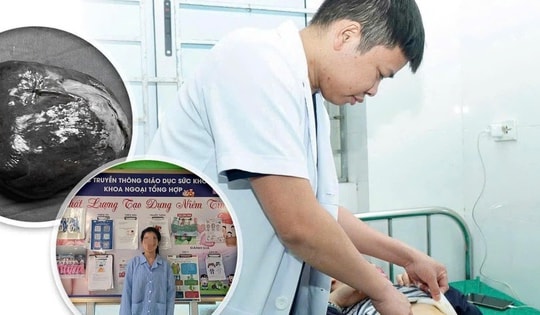 Phẫu thuật cắt lách bán phần điều trị u nang lách khổng lồ