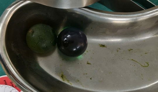 Nhiều trẻ nhỏ bị tắc ruột do nuốt hạt nở đồ chơi