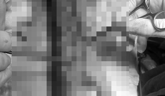 Dựng cây nêu vướng dây điện, người phụ nữ nguy cơ mất cẳng tay