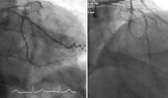 Can thiệp kịp thời cứu cụ ông 86 tuổi sốc tim nguy kịch