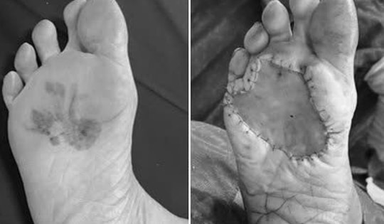 Vết đen ở bàn chân suốt 15 năm mới phát hiện ung thư