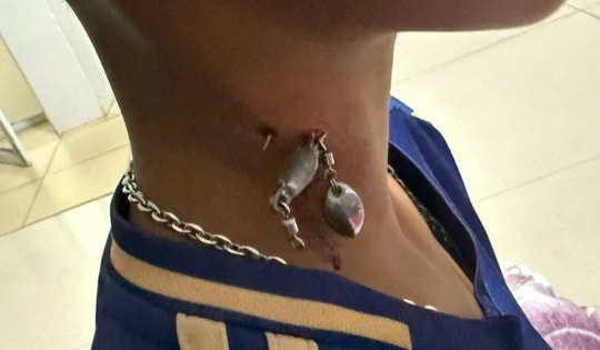 Móc câu cắm sâu vào cổ cậu bé