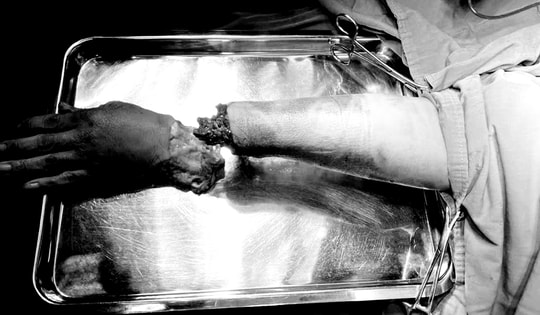 Nỗ lực giữ lại bàn tay công nhân bị dập nát do tai nạn lao động