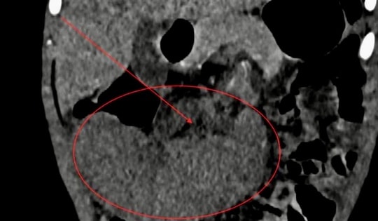 Phẫu thuật nội soi xử lý ca lách xoắn hiếm gặp ở trẻ 40 tháng tuổi