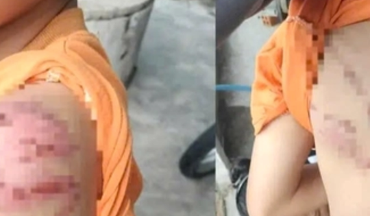 Công an điều tra vụ bé trai nghi bị cha ruột đánh