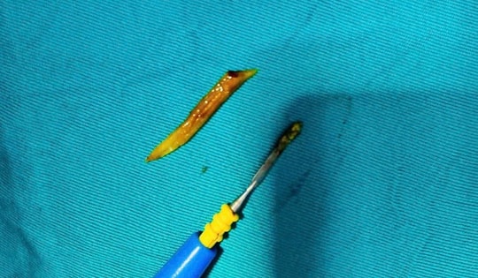 Nam bệnh nhân nhập viện cấp cứu vì xương cá kích thước lớn 'đi lạc' xuống... ruột non