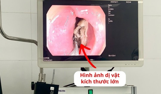 Lấy xương gà kích thước lớn mắc kẹt trong thực quản bệnh nhân
