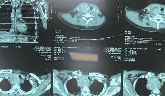 Chẩn đoán hình ảnh không cần phim in vào Quỹ BHYT chi trả