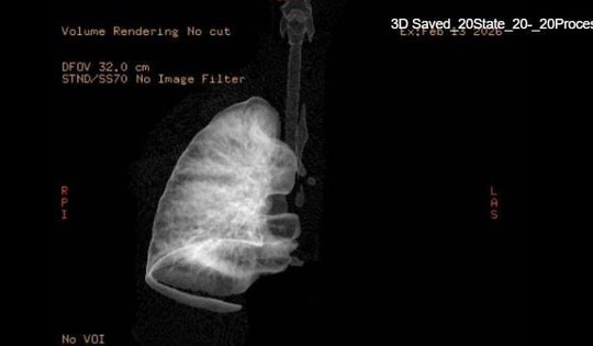 Gắp mảnh nhựa sắc nhọn, cứu bé 7 tuổi xẹp hoàn toàn phổi trái