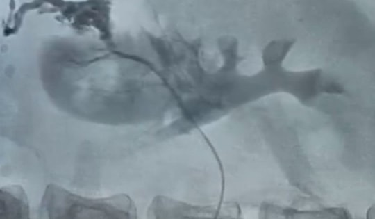 Bệnh viện 19-8 cấp cứu ca vỡ thận nguy kịch