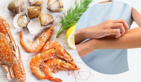 Bộ Y tế khuyến cáo sau một số vụ nghi ngộ độc, nhập viện liên quan đến hải sản