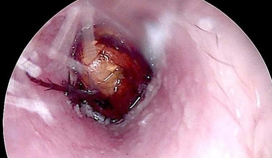 Nhờ tiệm cắt tóc lấy dị vật, bệnh nhân bị xung huyết ống tai