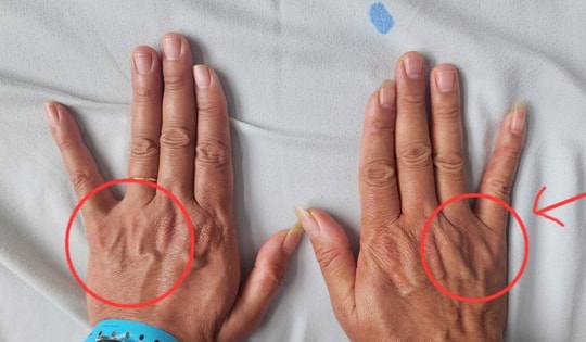 Tê ngón út kéo dài, người đàn ông suýt teo cơ bàn tay