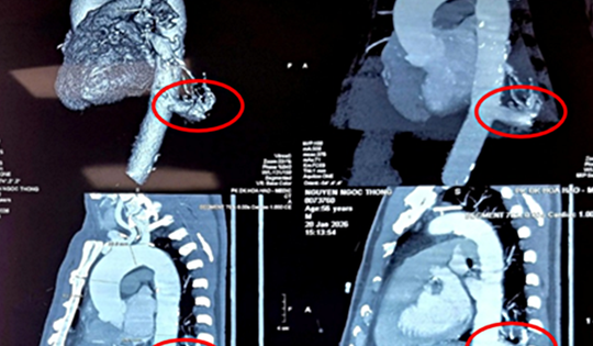 Bệnh viện Bình Dân phẫu thuật robot cắt phổi biệt lập, xử trí dị tật hiếm gặp trong lồng ngực