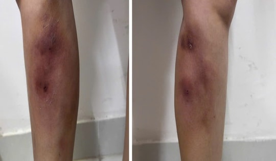 Cẳng chân người phụ nữ 29 tuổi biến dạng vì tiêm filler để làm... thẳng chân tại nhà