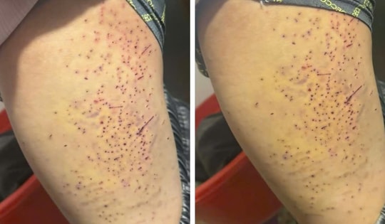 Đã rõ nguyên nhân học sinh lớp 7 ở Lào Cai bị bạn cùng lớp dùng bút đâm vào đùi