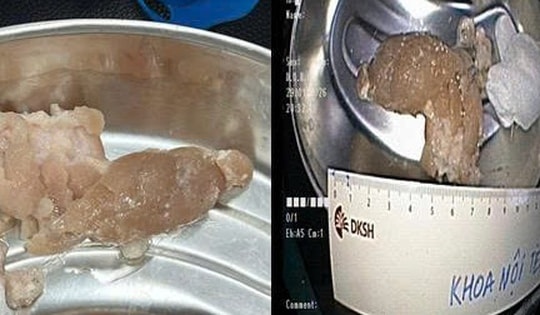 Nuốt vội miếng thịt trong bữa tối, người đàn ông suýt tắc thở