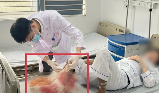 Suýt mất chân sau 1 tháng tự đắp lá chữa bỏng tại nhà