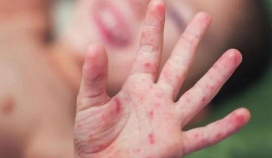 Lâm Đồng giám sát người tiếp xúc gần sau ca bệnh viêm màng não mô cầu