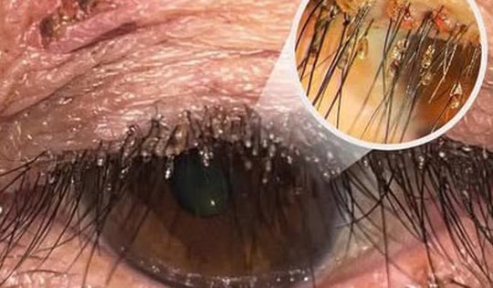 Phát hiện ổ rận mu bám dày trên mí mắt người phụ nữ