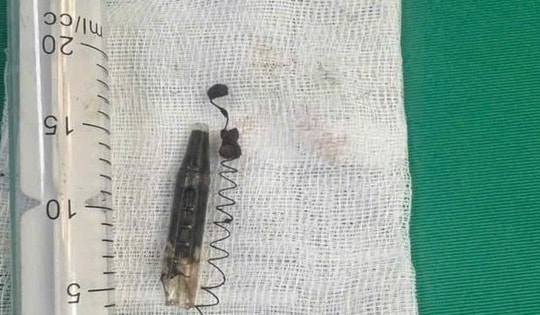 Phẫu thuật lấy dị vật lò xo bút bi 'ngủ quên' 13 năm trong vùng thái dương