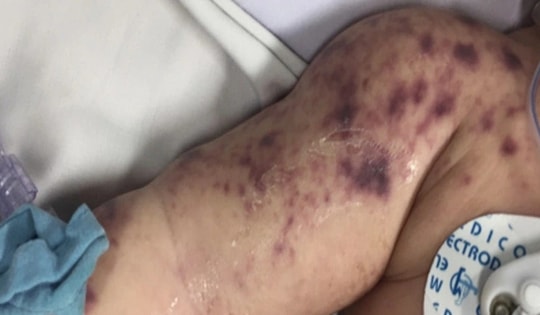 Sở Y tế An Giang xác nhận trẻ tử vong ở Phú Quốc do viêm não mô cầu