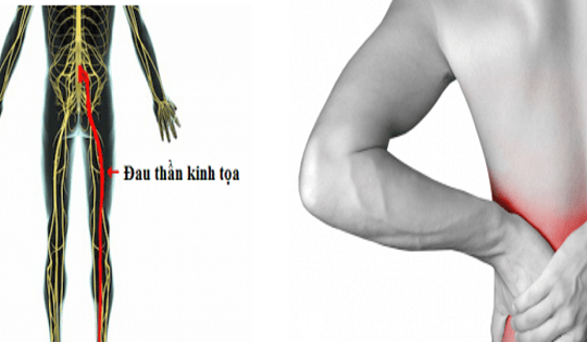 Vitamin và khoáng chất nào tốt cho người đau thần kinh tọa?