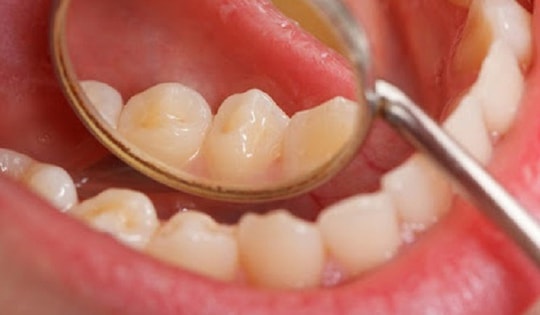 Ngoài thuốc lá, yếu tố nào làm tăng nguy cơ ung thư khoang miệng?