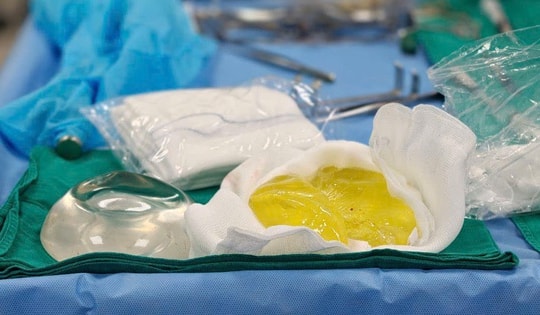 Người phụ nữ tá hoả vì túi ngực vỡ vụn sau 5 năm dù không có cảm giác đau