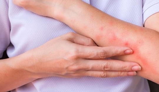Viêm da dị ứng mùa Xuân: Lưu ý khi tự điều trị, tránh lạm dụng thuốc bôi