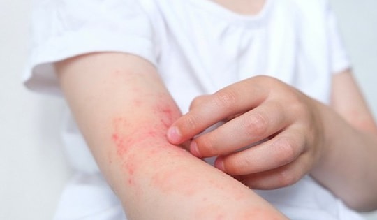 Cách chọn kem dưỡng ẩm trong liệu trình điều trị viêm da dị ứng tốt nhất