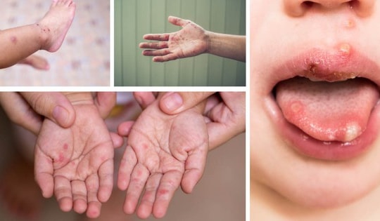 Gần 25.000 ca mắc tay chân miệng, tăng gấp 5 lần: Bộ Y tế chỉ đạo khẩn