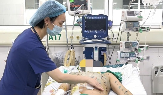 Nhiều người lớn mắc thủy đậu biến chứng nguy kịch