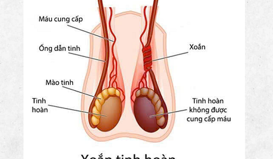 Nam sinh 14 tuổi phải cắt bỏ tinh hoàn do nhập viện muộn