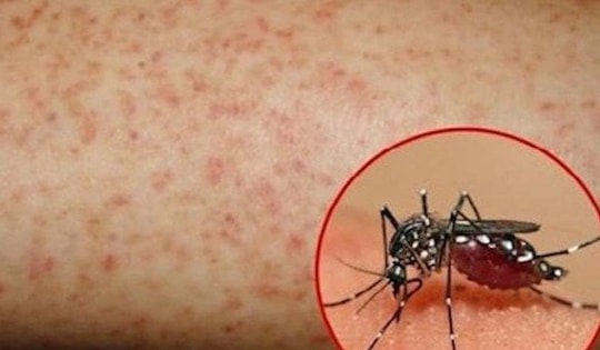 Nguy cơ dịch sốt xuất huyết gia tăng, Lâm Đồng yêu cầu tăng cường giám sát dịch