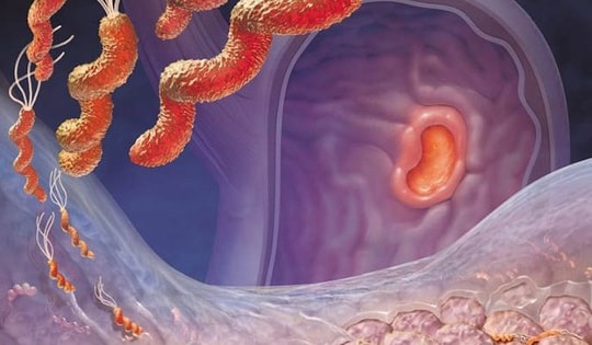 Viêm loét dạ dày – tá tràng: Dùng thuốc đúng cách để bảo vệ niêm mạc