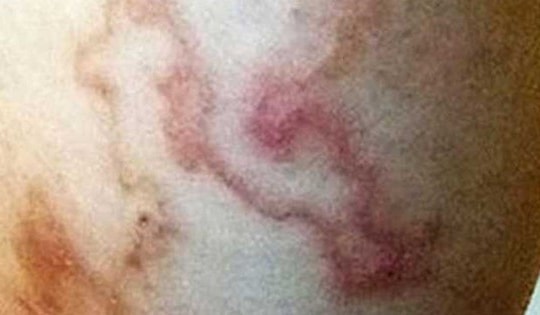 Bệnh ký sinh trùng nhiều người dương tính khi xét nghiệm ở Khánh Hòa nguy hiểm mức nào nếu không điều trị sớm?