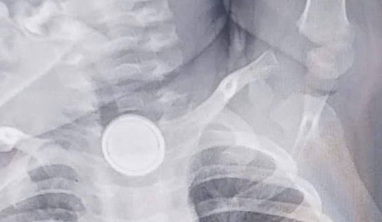 Nuốt pin cúc áo, bé 2 tuổi bỏng nặng thực quản